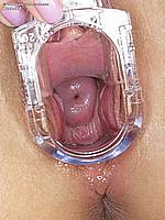 341_091_large-labis-minora-speculum